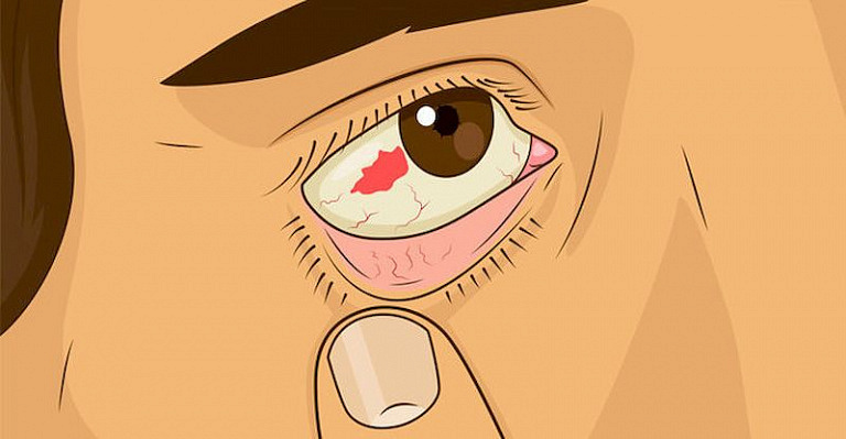 Глаза, в которых живет болезнь: 11 глазных симптомов, указывающих на неполадки со здоровьем