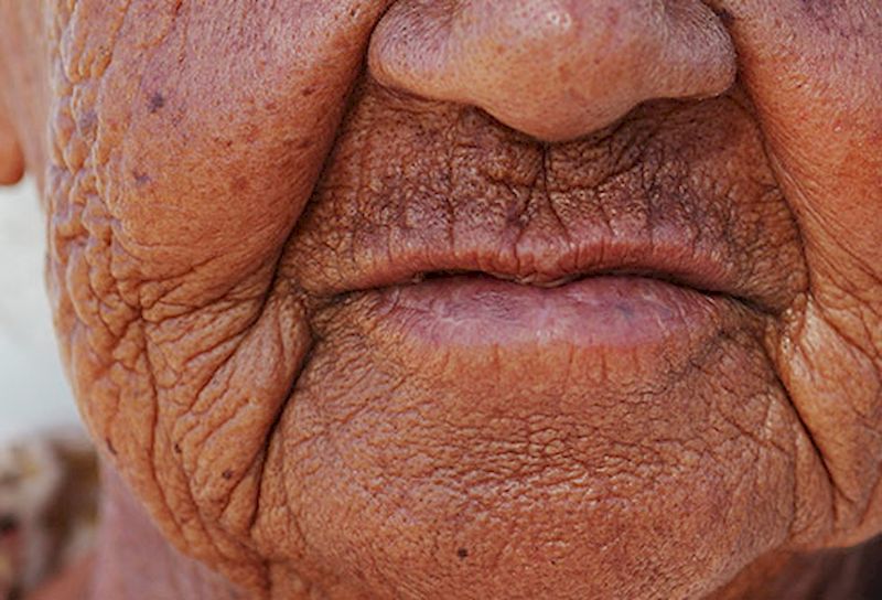 15 возрастных болезней кожи, которые нас всех поджидают