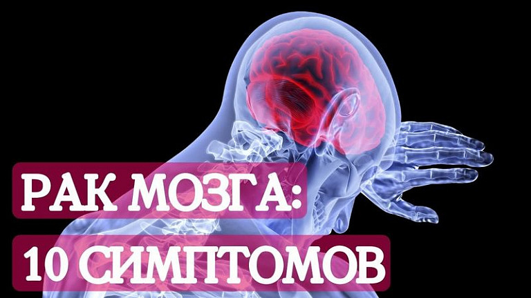 Опухоль головного мозга: 10 симптомов страшной болезни