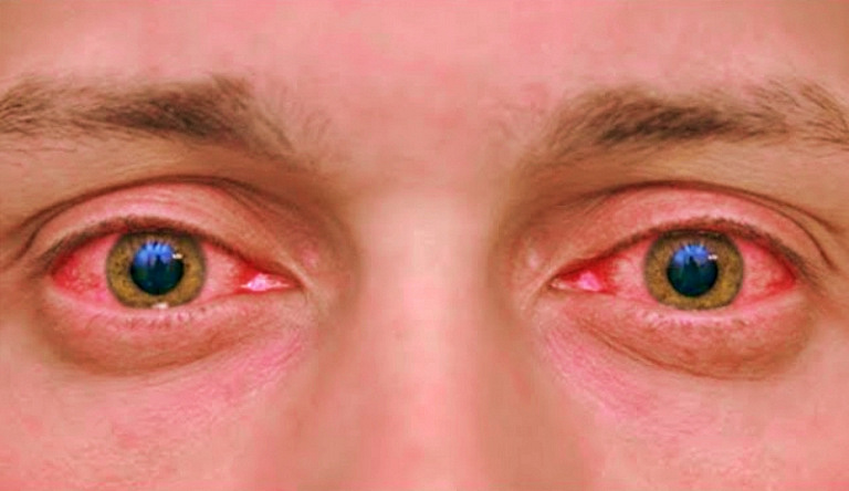 Как снять покраснение глаз 10 разными способами
