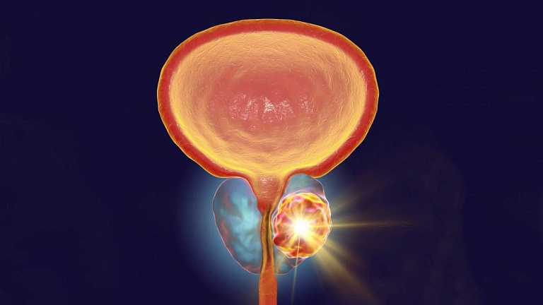 Стадирование рака простаты: методика, помогающая решить, какое лечение нужно