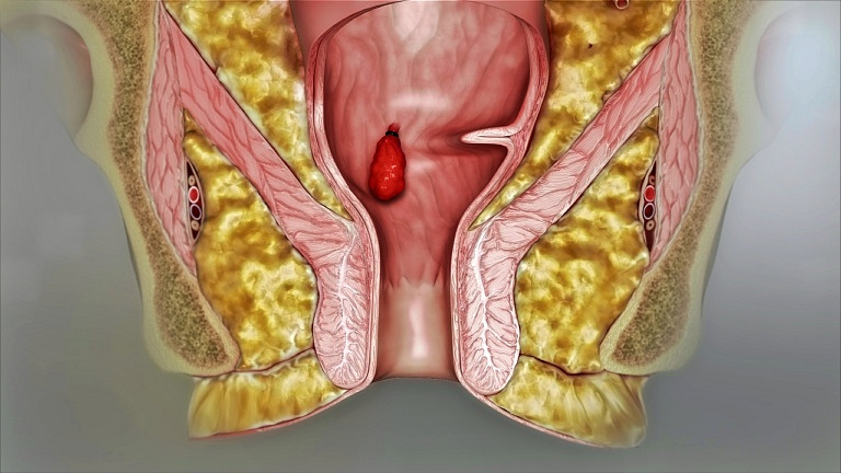 Геморрой: откуда берется и что делать с этими всеми шишками