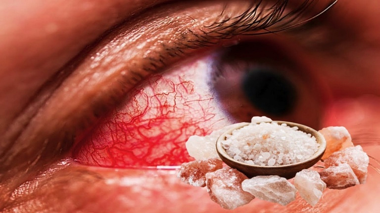 Ячмень на глазу и халязион: 3 быстрых способа вылечить глазную инфекцию в домашних условиях