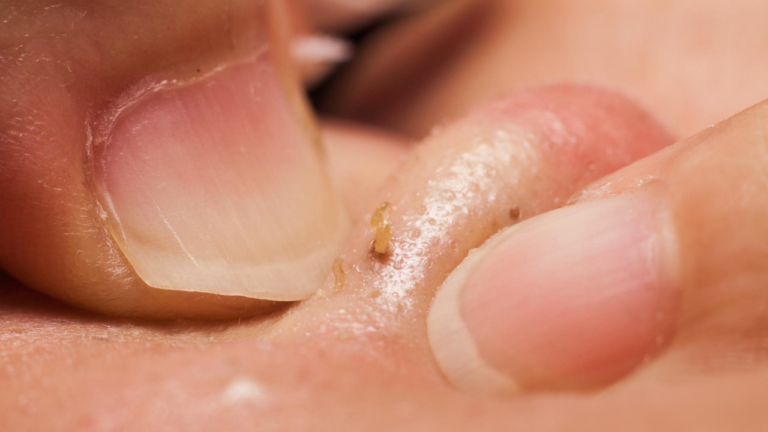 11 способов очистить кожу от сальных пробок и избавиться от угревой сыпи