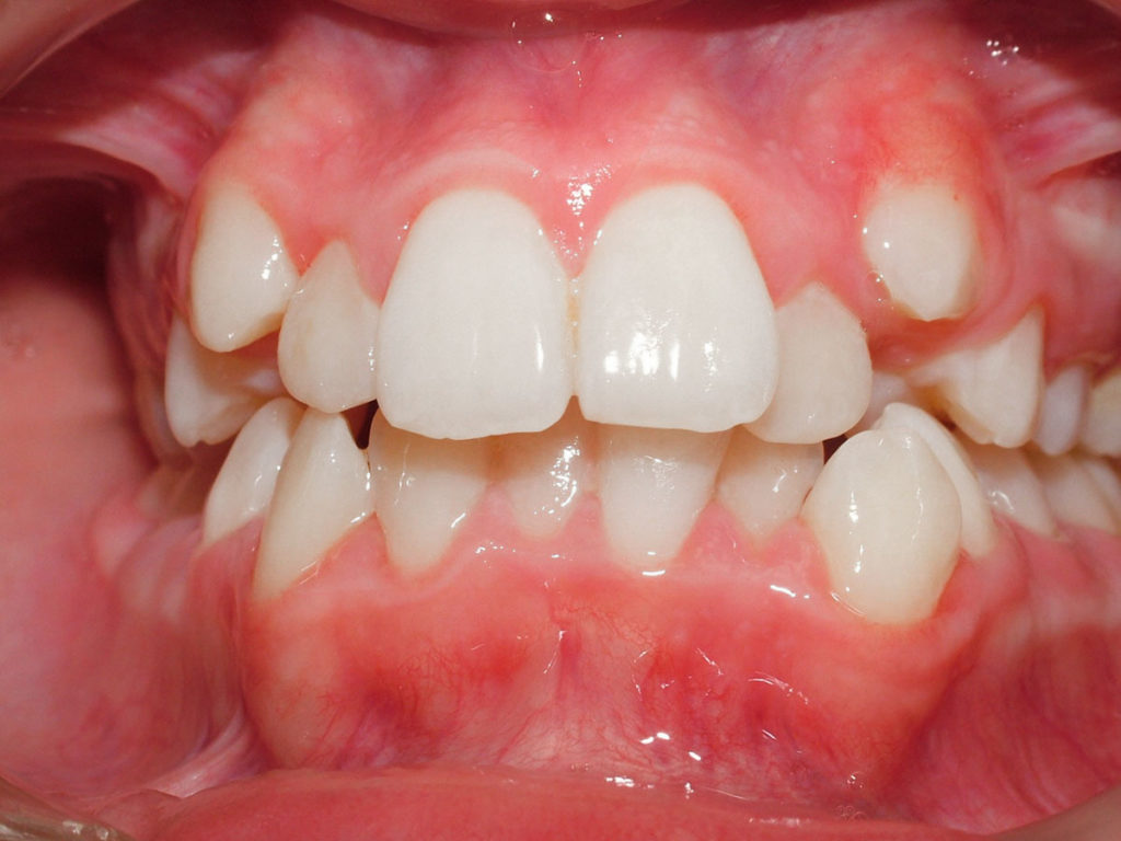 Ортодонтические пластинки – залог здоровых зубов и сияющей улыбки вашего ребенка