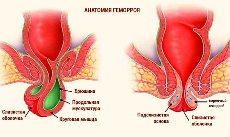 Что такое геморрой?