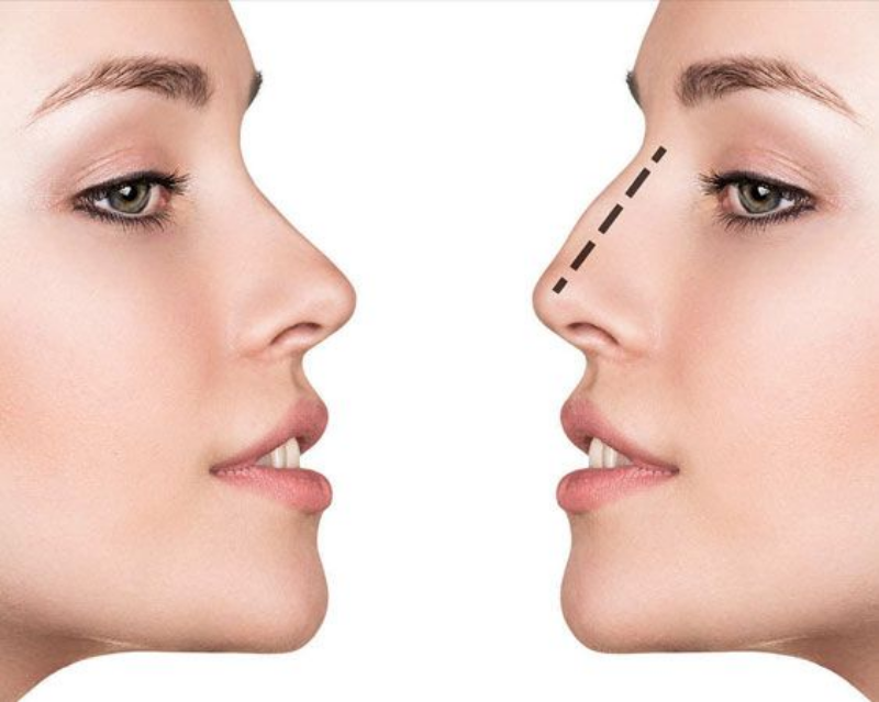 Коррекция формы носа: 4 шага к совершенству