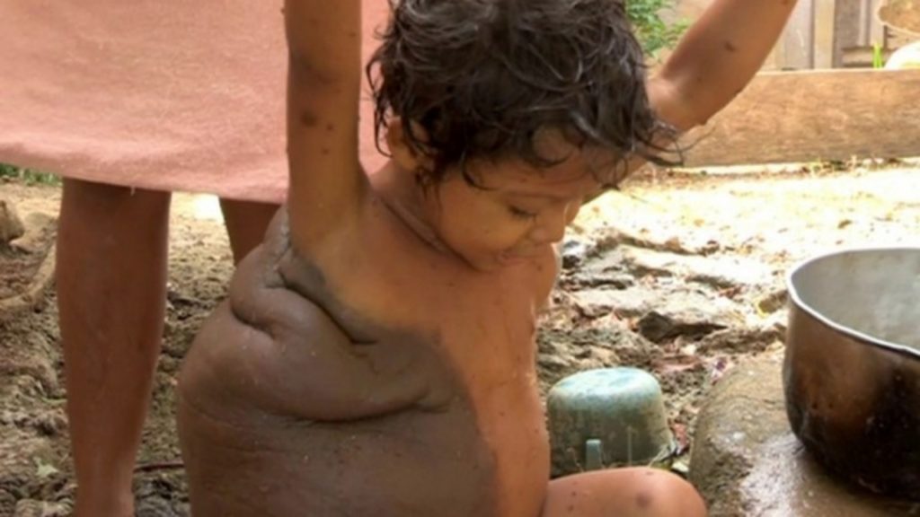Мальчик-черепаха: родинка на спине ребенка стала такой большой, что выглядела как панцирь черепахи
