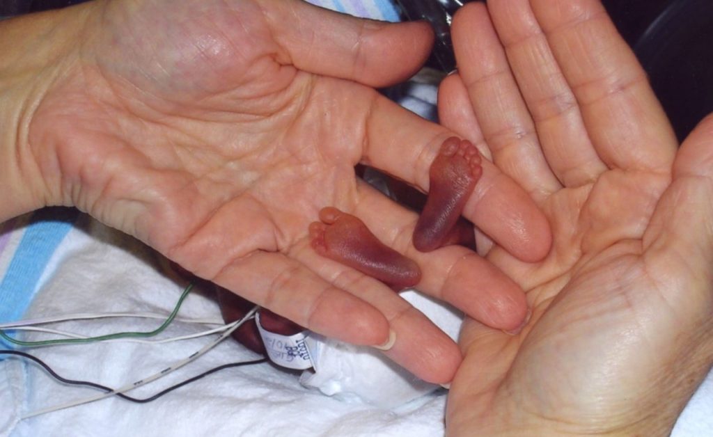 Этот малыш весил чуть больше 200 граммов, когда родился, но врачи сделали невозможное