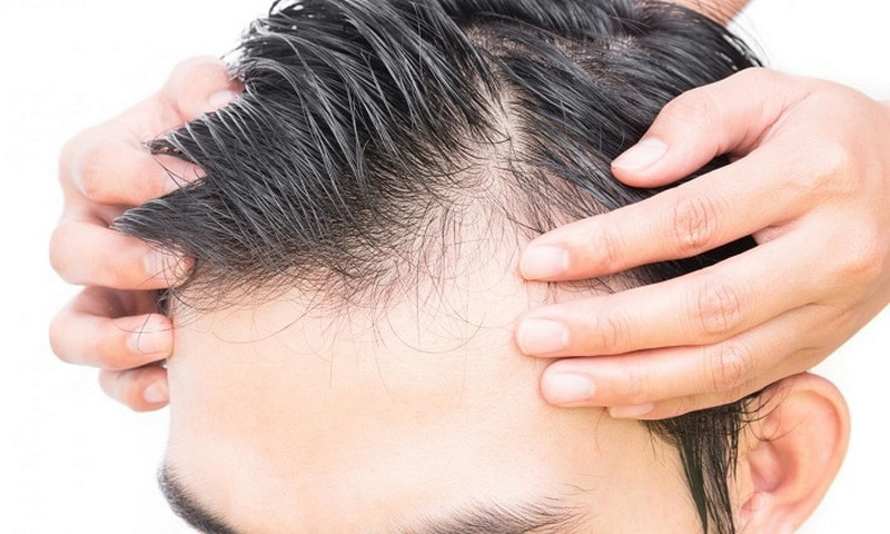 Описание процедуры пересадки волос на лоб