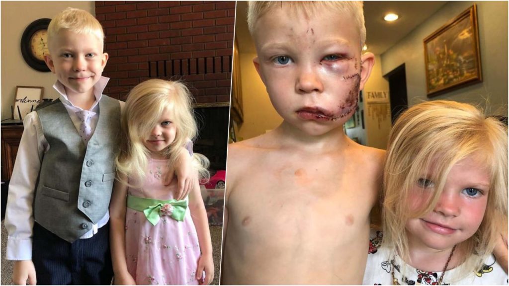 Мальчик вступился за 4-летнюю сестренку, на которую напала агрессивная собака – и получил 90 швов