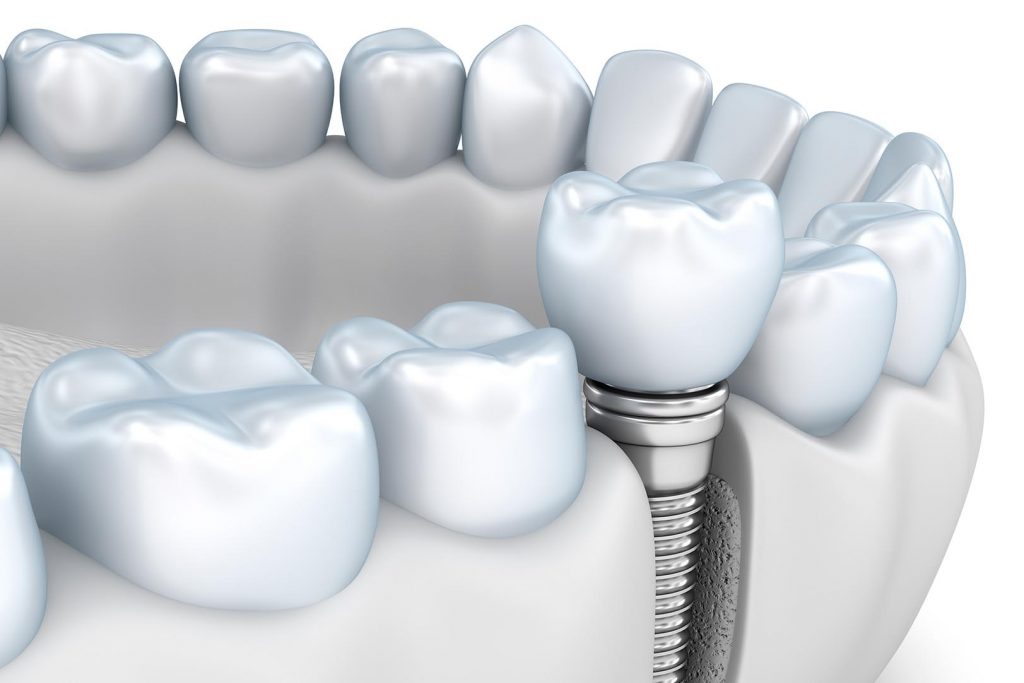 Имплантация зубов в Dent-lux