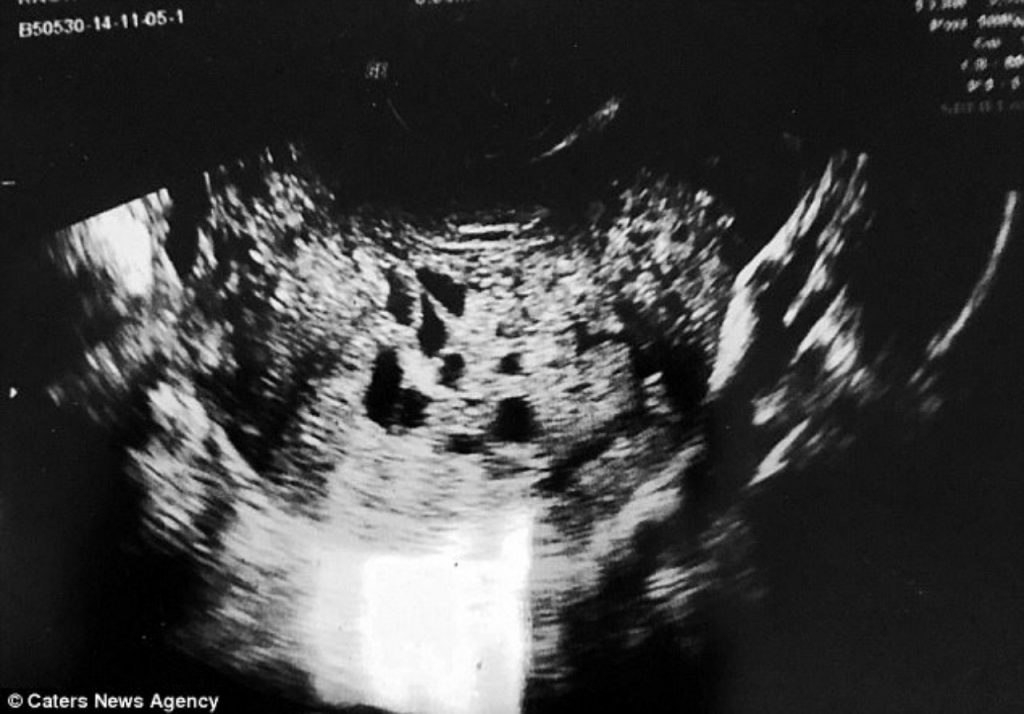 Беременная девушка родила в туалете больницы ЭТО – врачи до сих пор приходят в себя