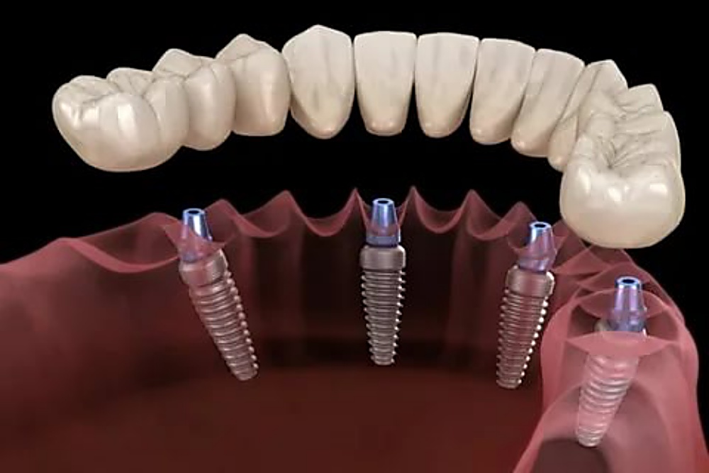 Виды и особенности протезирования зубов
